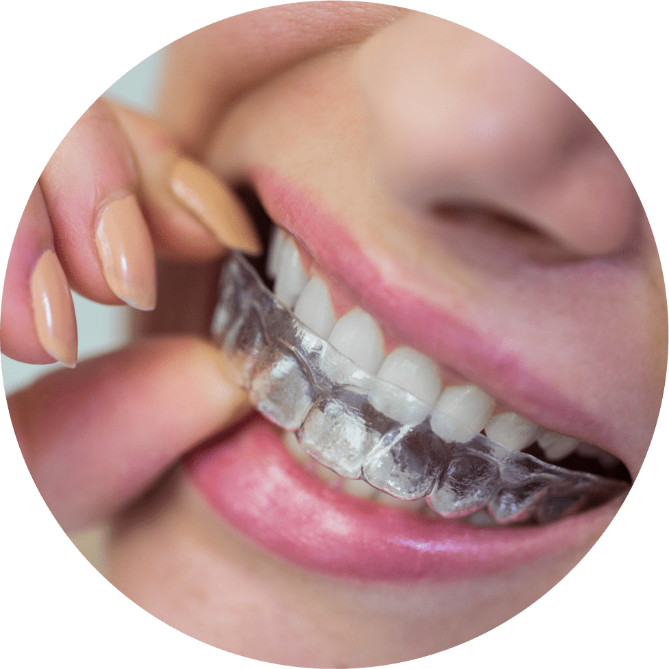 invisible braces with color