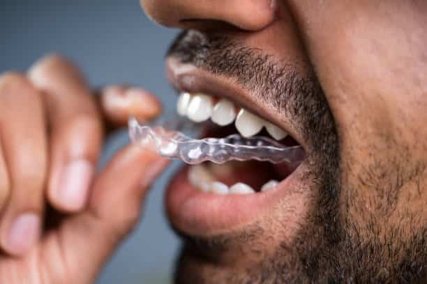 clear aligners for adults