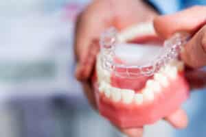 clear aligners for adults